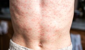 Salud pidió fortalecer la vigilancia por casos de sarampión